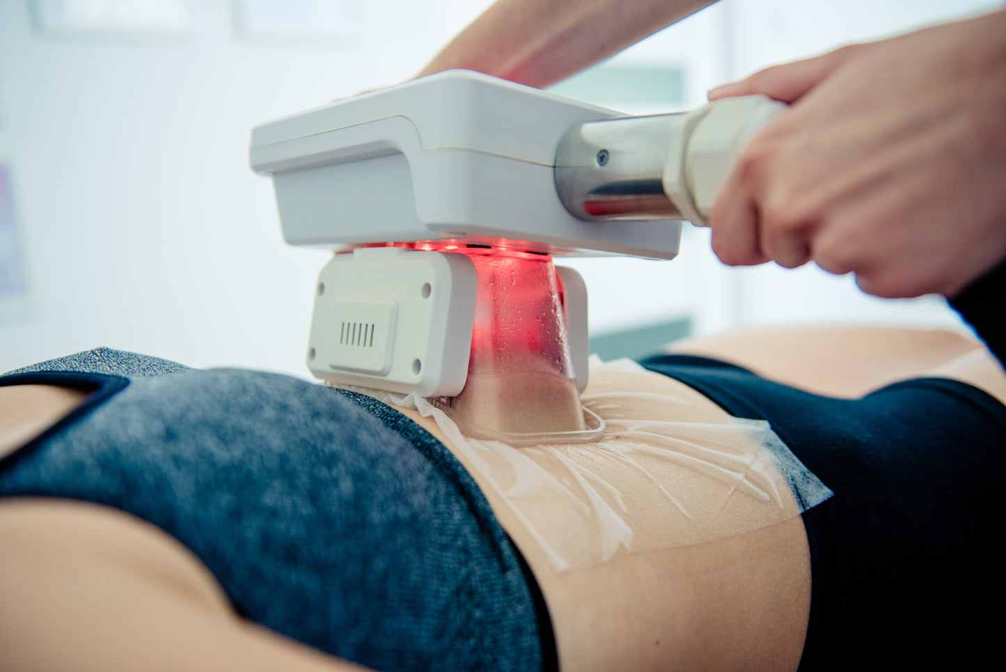 Kriolipoliza 3 przyłożenia +  Emsculpting na 2 partie ciała